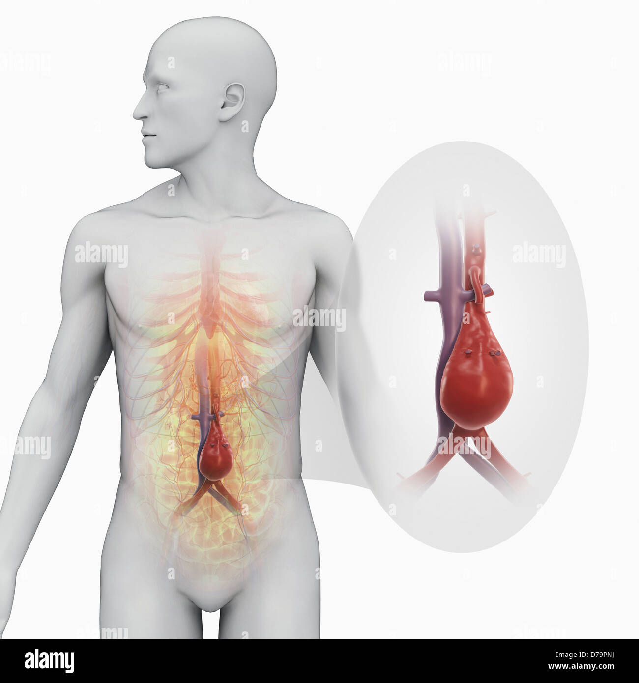 Abdominalen Aortenaneurysma Stockfoto