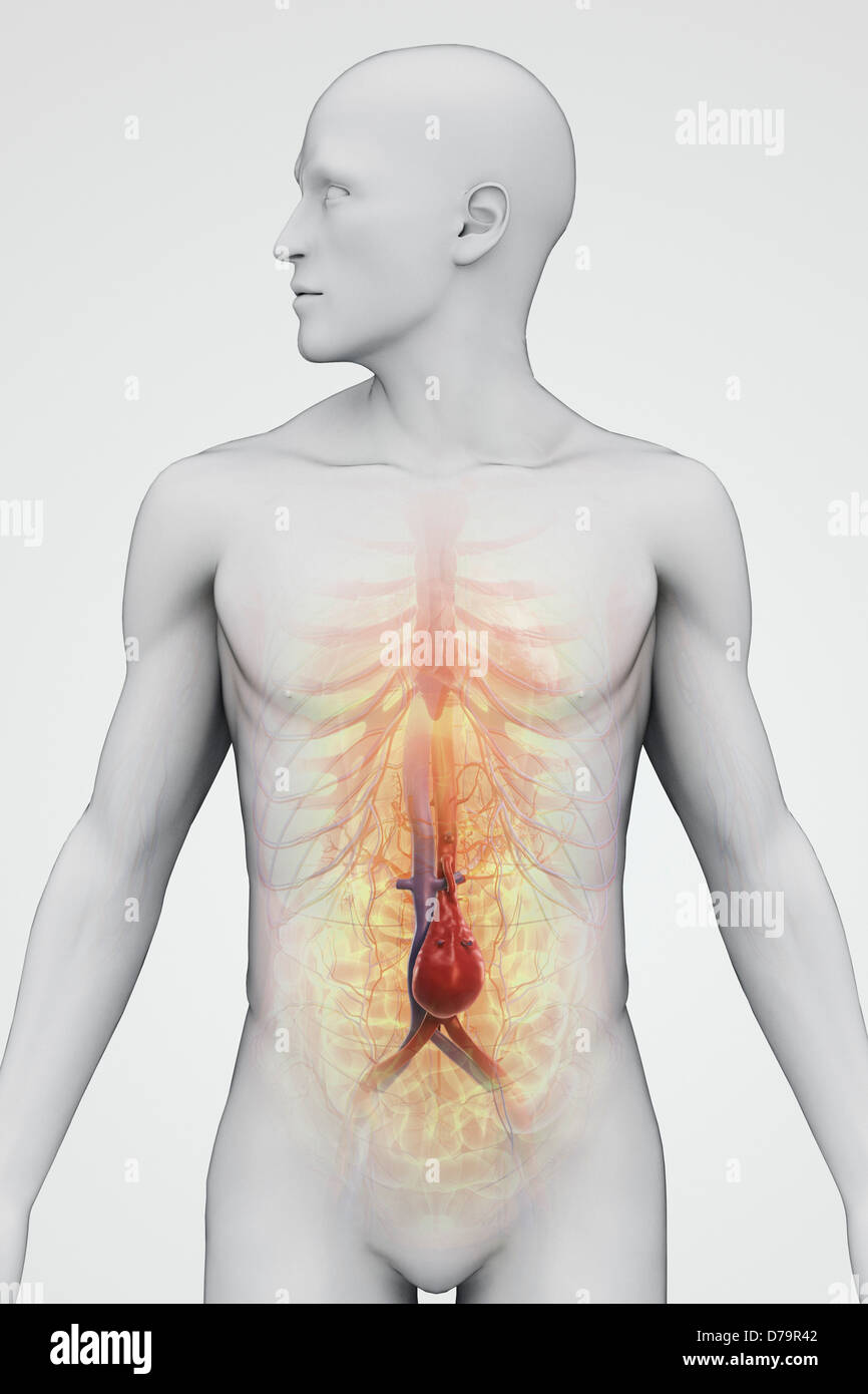 Abdominalen Aortenaneurysma Stockfoto