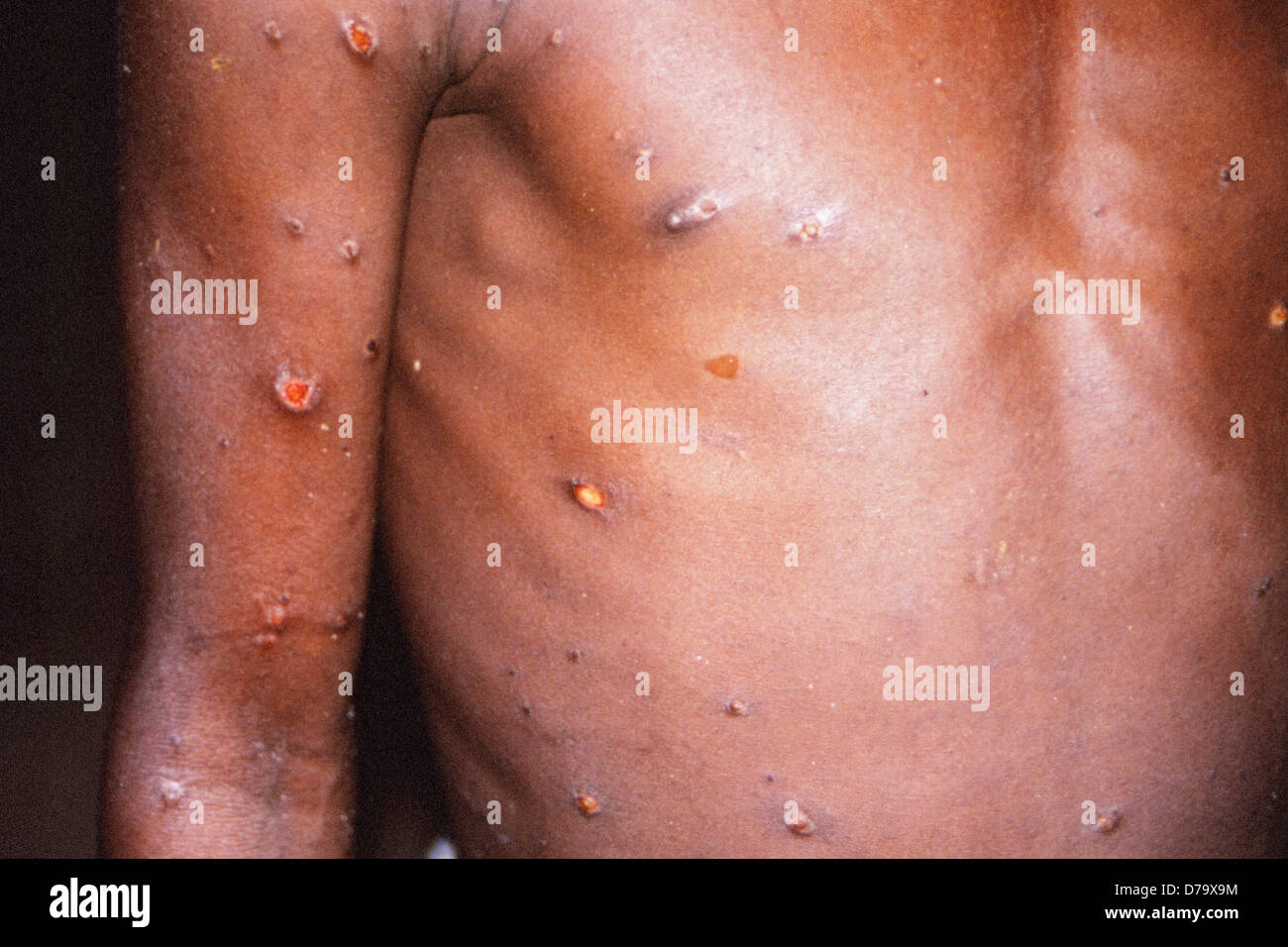 Monkeypox Patienten Stockfotografie Alamy