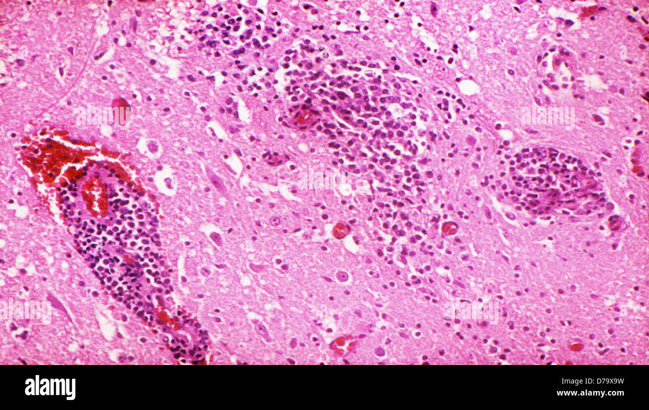 Equine Hirngewebe West-Nil-Virus infiziert Stockfoto