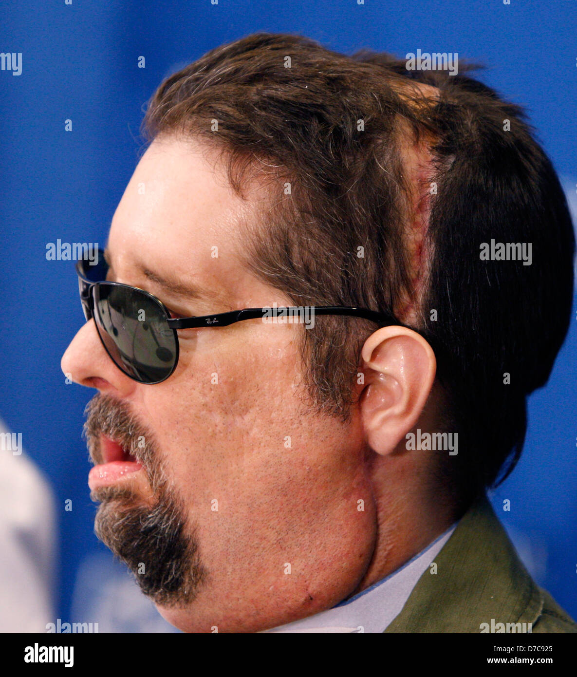 Dallas Wiens Gesicht Transplantempfänger, Fort Worth, Texas, auf einer Pressekonferenz am Brigham and Women es Hospital. Wiens ist Stockfoto