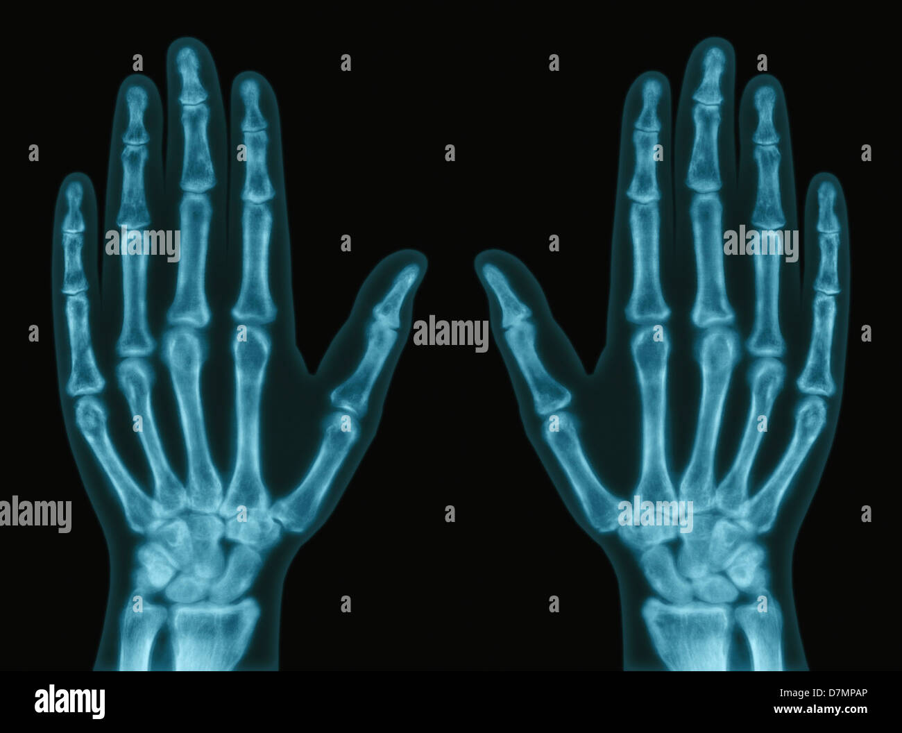 Hände, x-ray Stockfoto