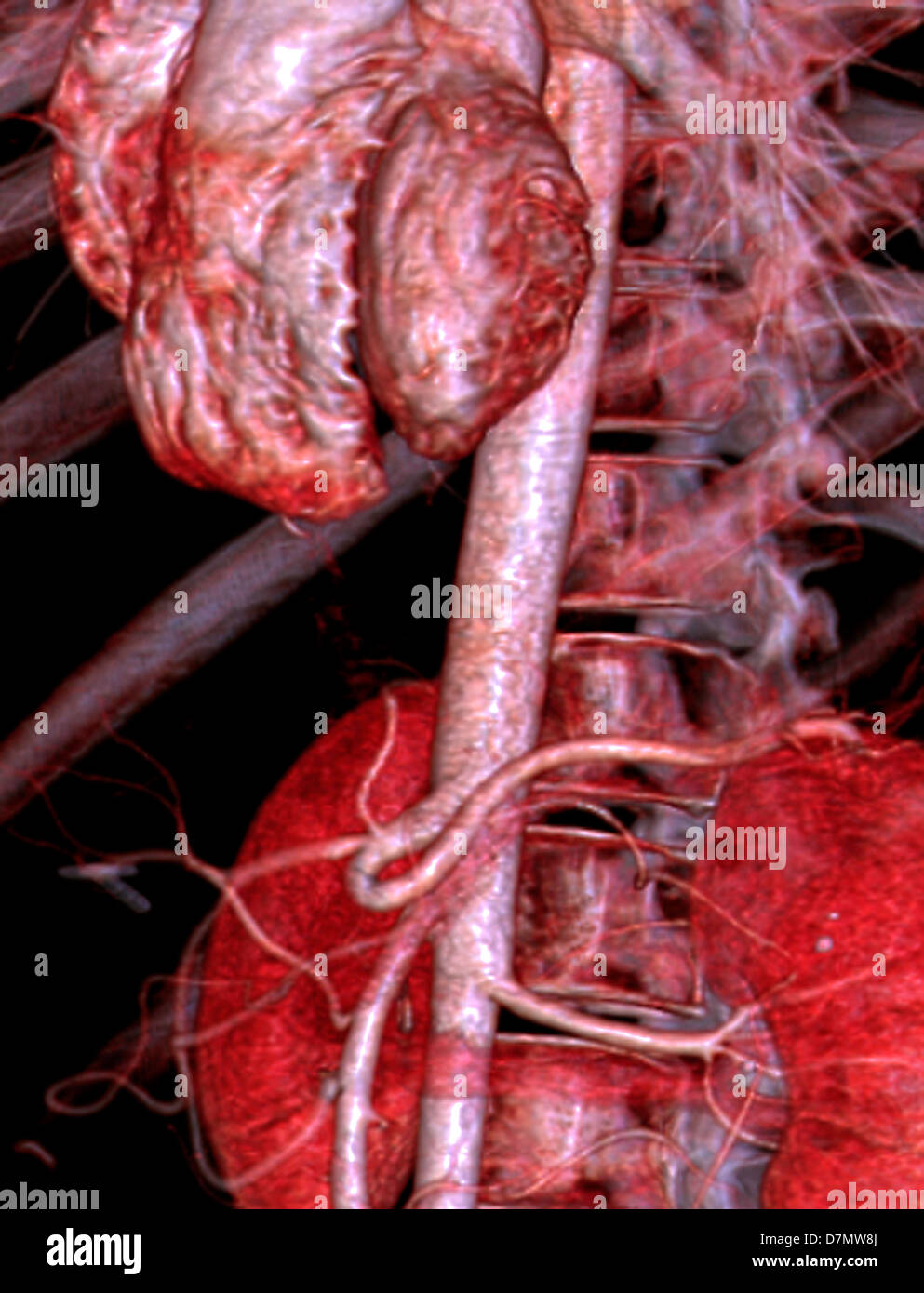 Abdominal aorta 3d ct scan -Fotos und -Bildmaterial in hoher Auflösung ...