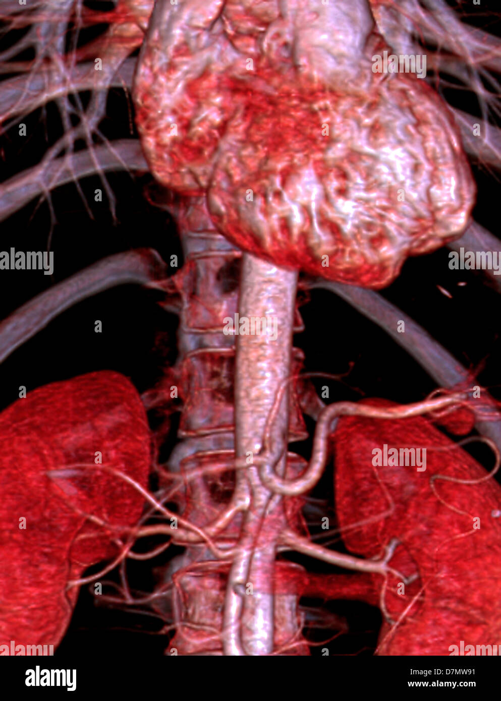 Abdominal aorta 3d ct scan -Fotos und -Bildmaterial in hoher Auflösung ...