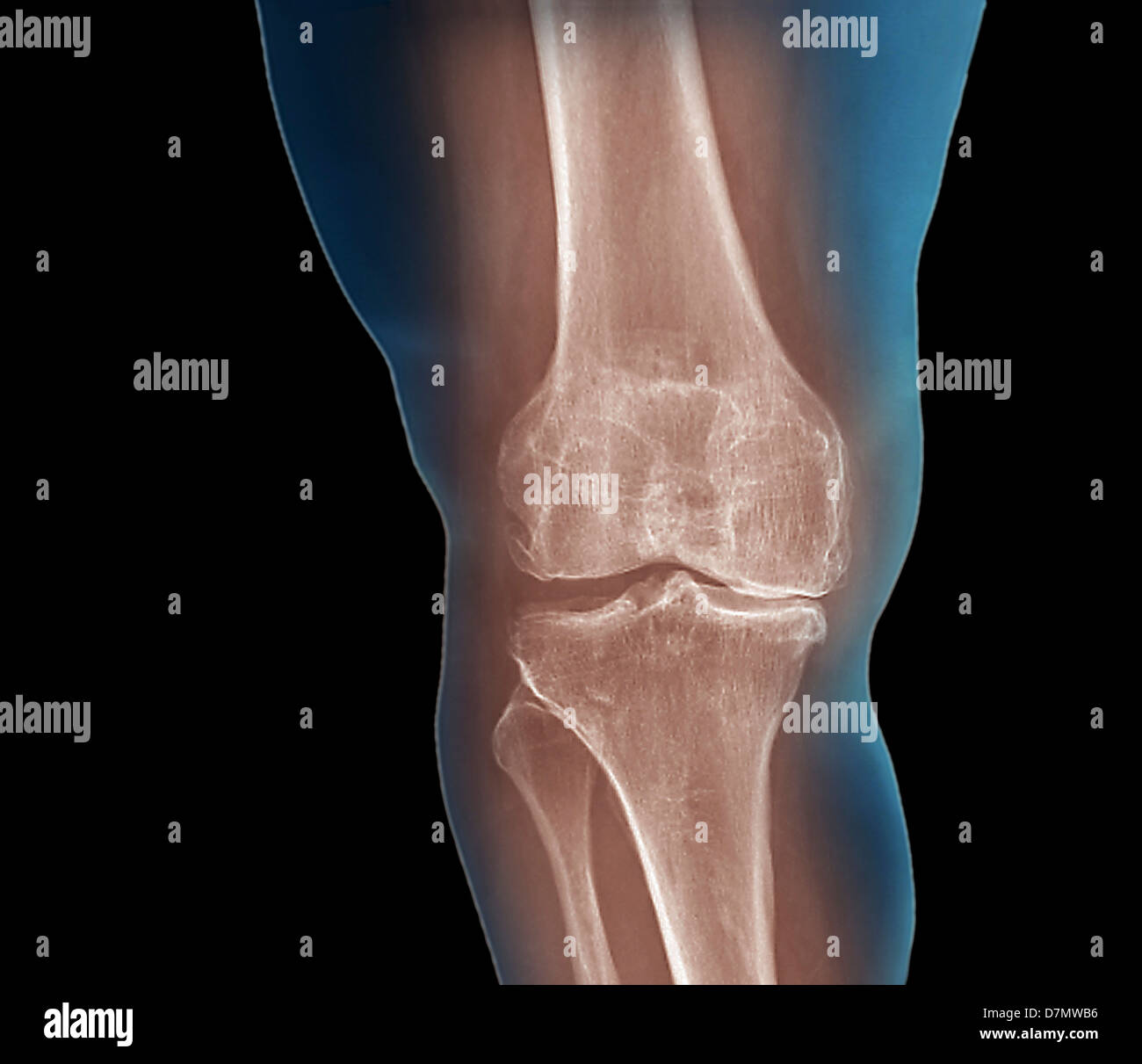 Arthritis des Knies, x-ray Stockfoto