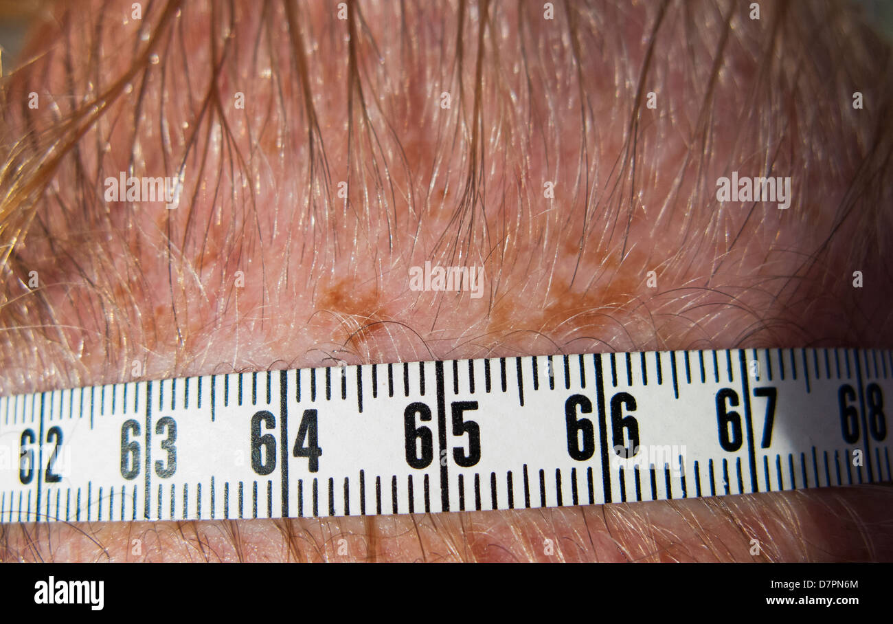 Beispiel dafür, wie misst man die Grösse der verdächtige Haut Sommersprossen oder Maulwurf. Auf Kopf verwendet Maßband neben Sommersprossen zeigt seine Größe. Stockfoto