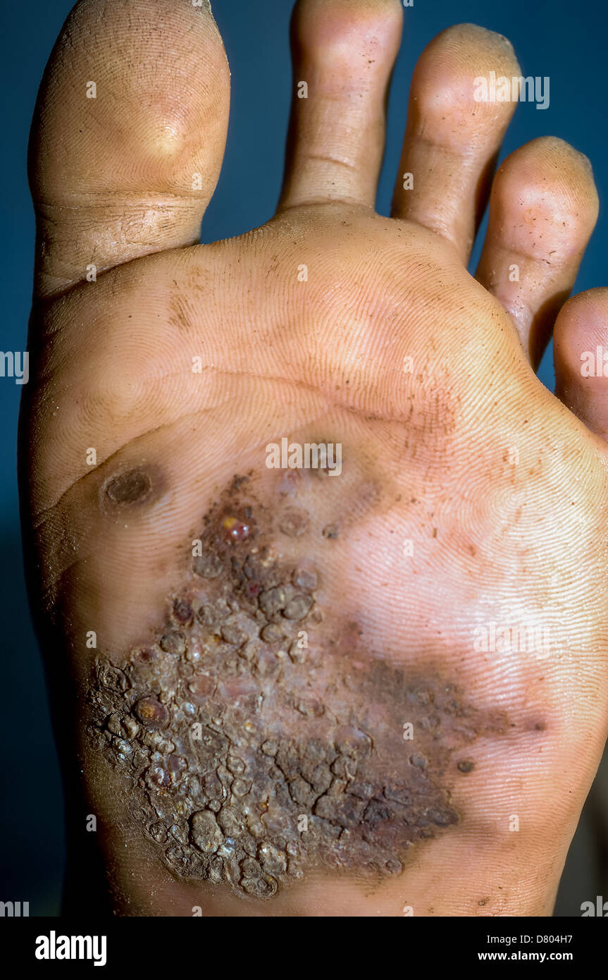 Eumycetoma in den linken Fuß eines Patienten. Stockfoto