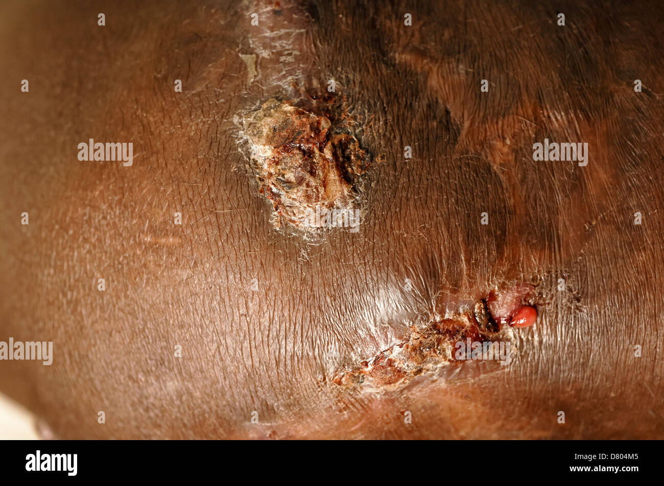Myzetom auf das rechte Knie eines Patienten. Stockfoto
