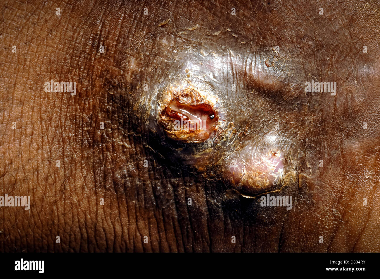 Nahaufnahme von einem geheilten Eumycetoma am Knöchel des 20 Jahre alt, männlich. Stockfoto