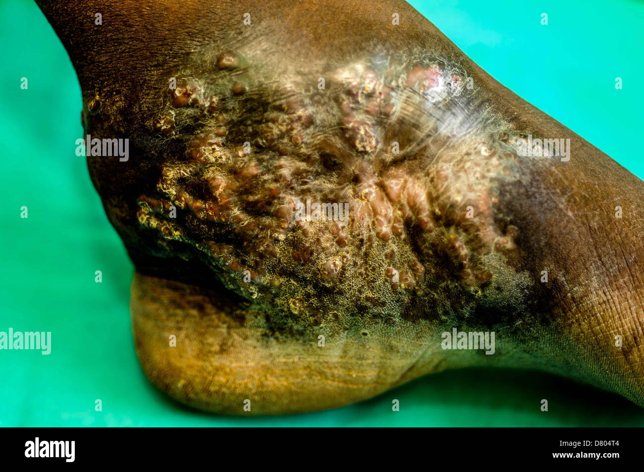 Actinomycetoma Auswirkungen auf den Knöchel von einem älteren Mann aus dem Sudan. Stockfoto