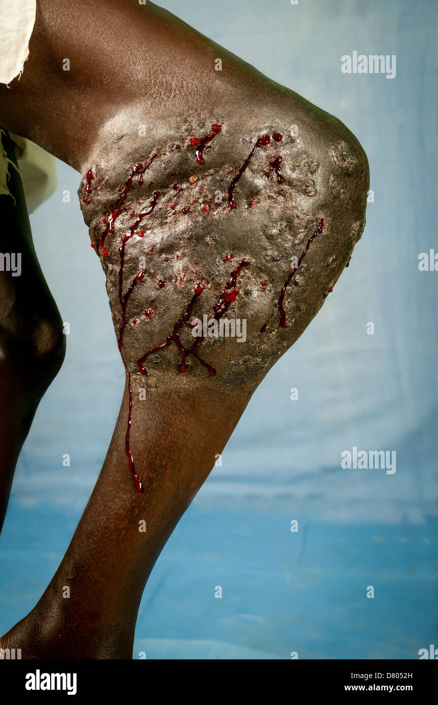 Blut sickerte aus den Nebenhöhlen ein 27 Jahre alter Mann Bein mit Eumycetoma unter dem rechten Knie. Stockfoto