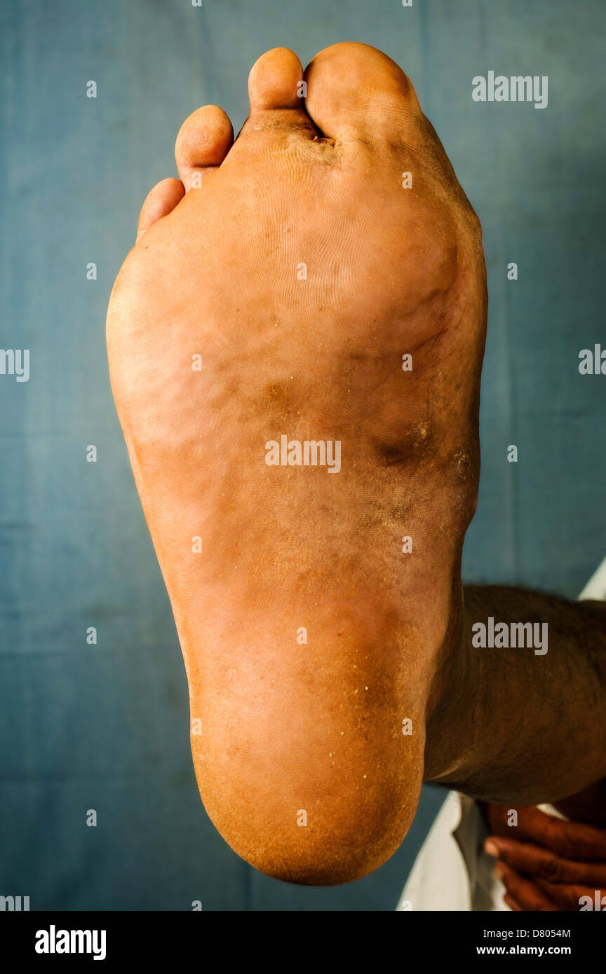 Actinomycetoma des rechten Fußes. Stockfoto
