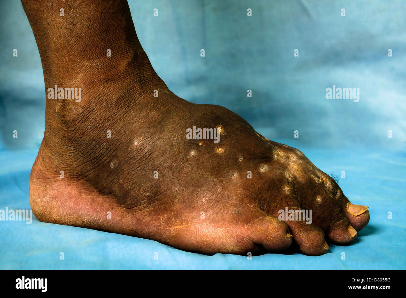 Actinomycetoma des linken Fußes. Stockfoto