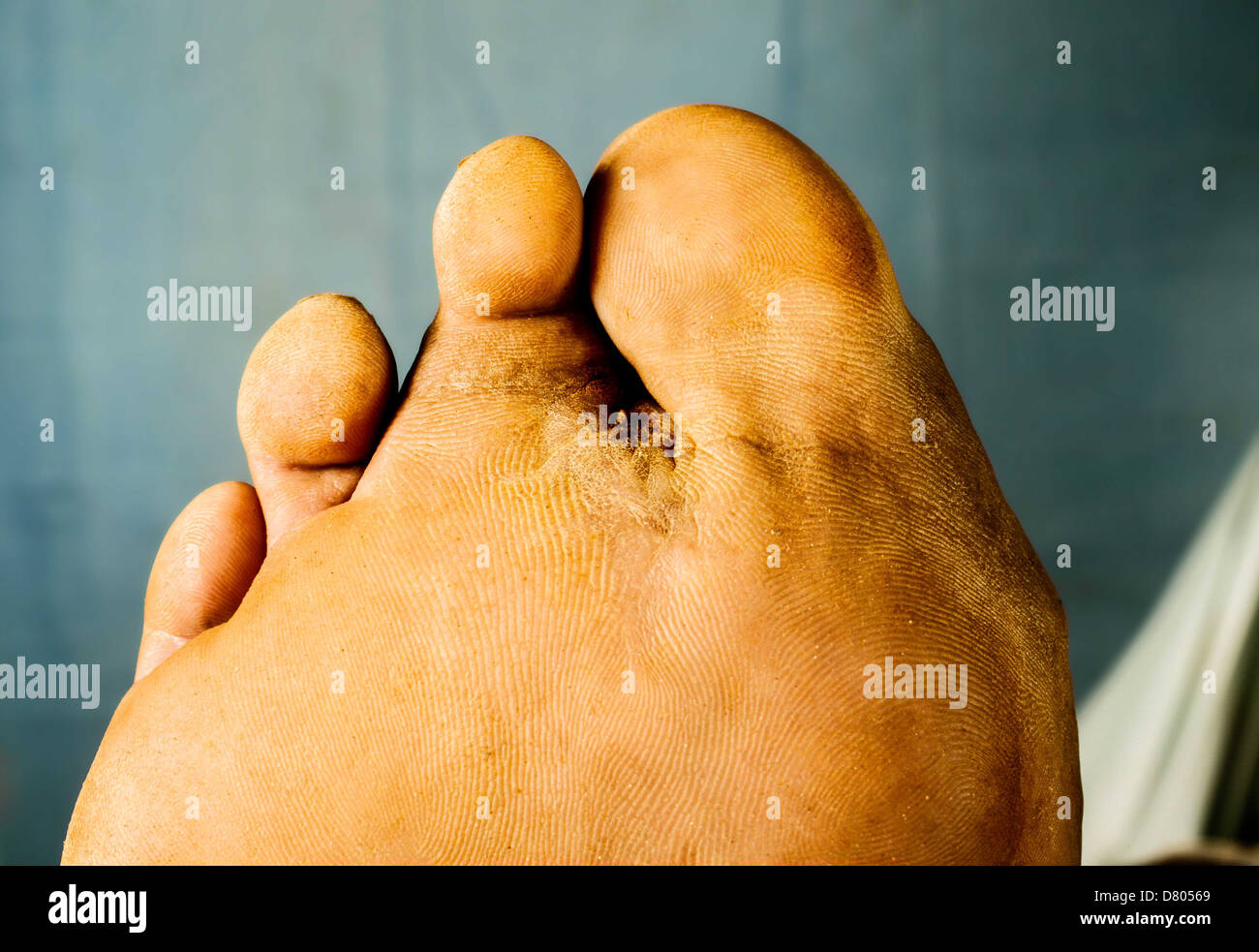 Actinomycetoma des rechten Fußes. Stockfoto