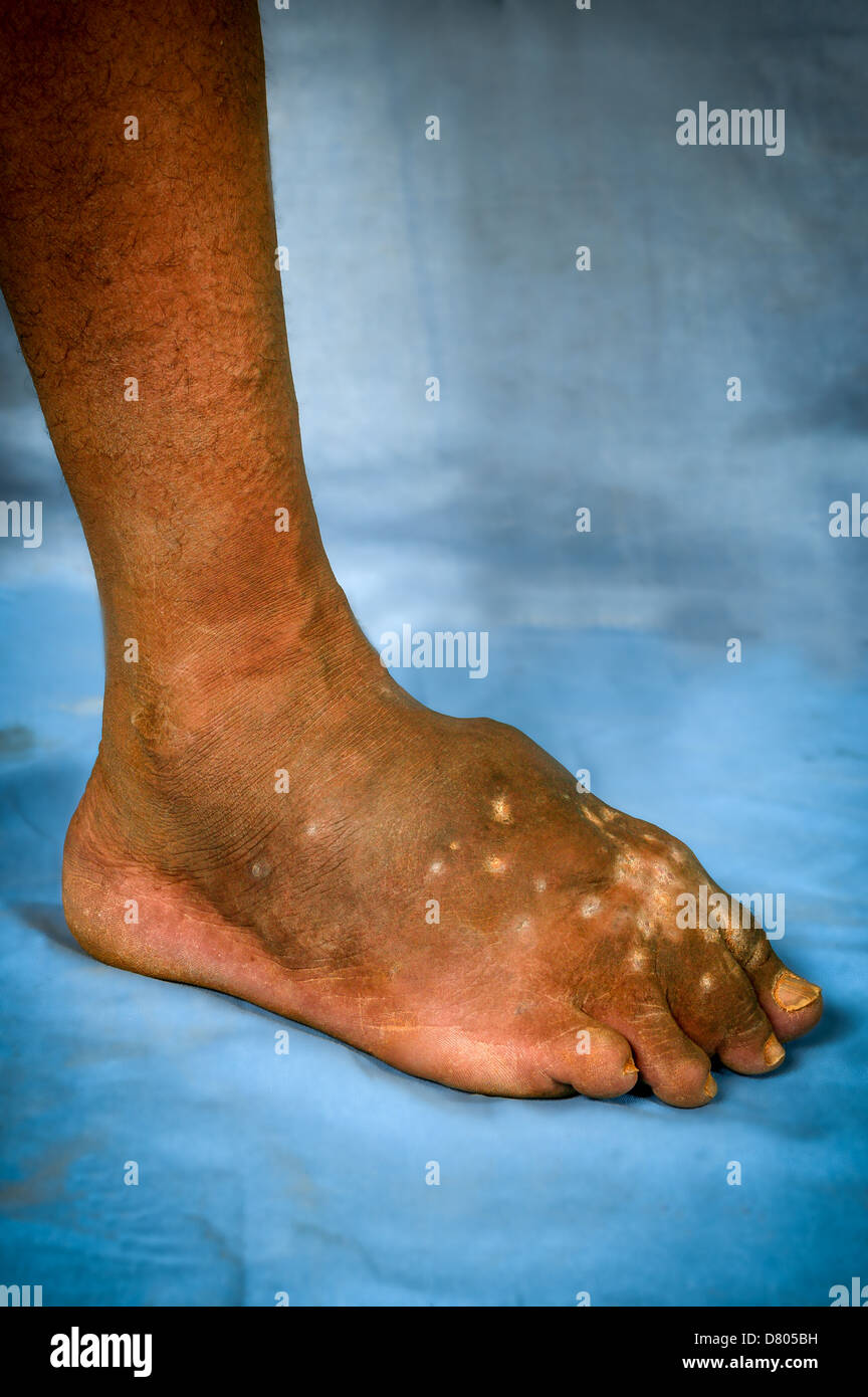 Actinomycetoma des linken Fußes. Stockfoto