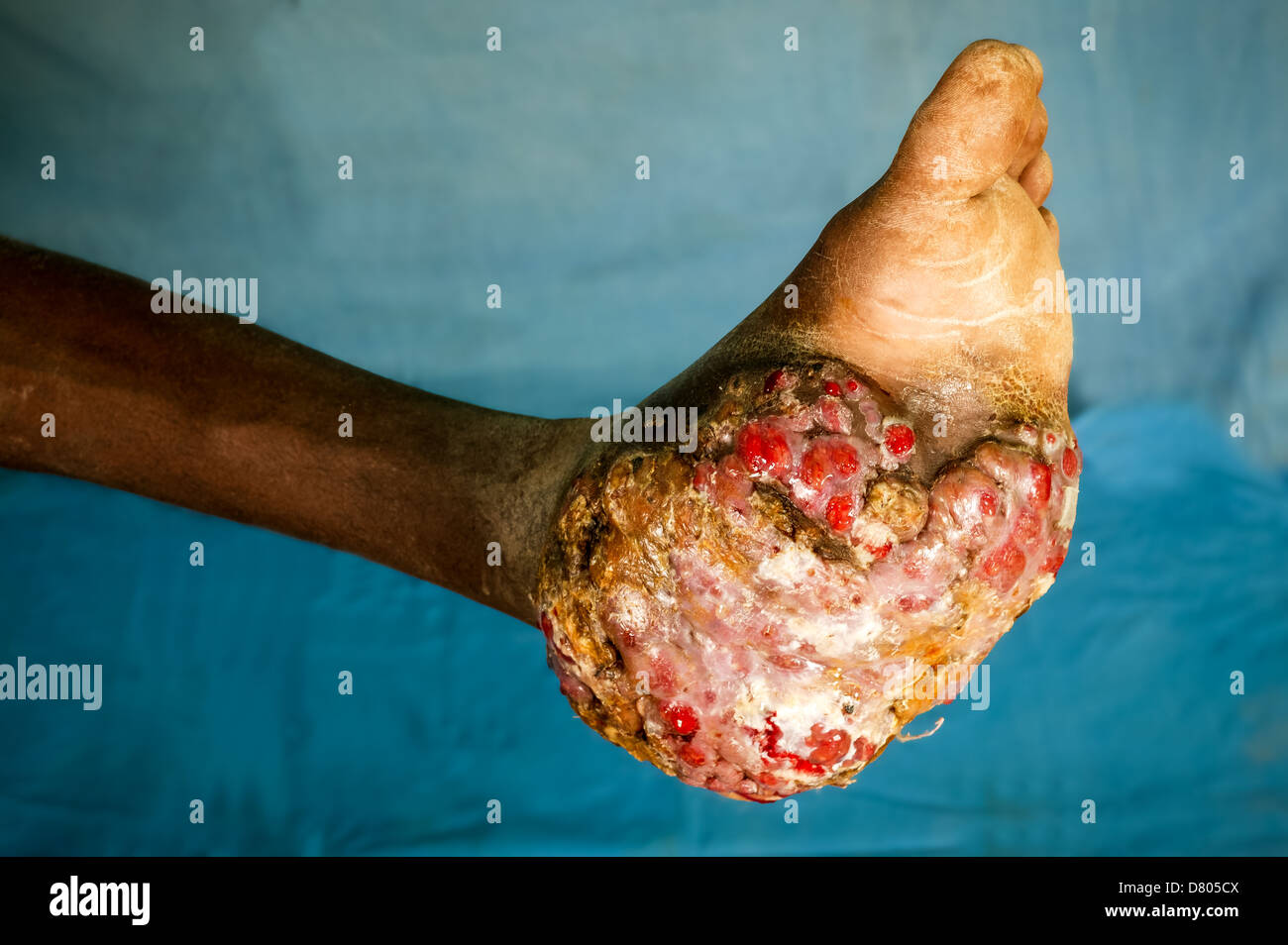 Schwere Eumycetoma des linken Fußes. Umfangreiche Schäden sind hier einsehbar. Stockfoto