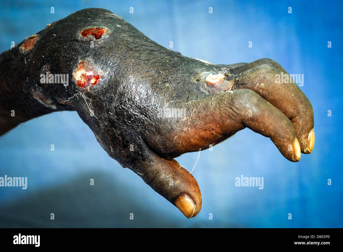 Nahaufnahme der linken Hand und Arm leiden unter schweren Eumycetoma. Stockfoto