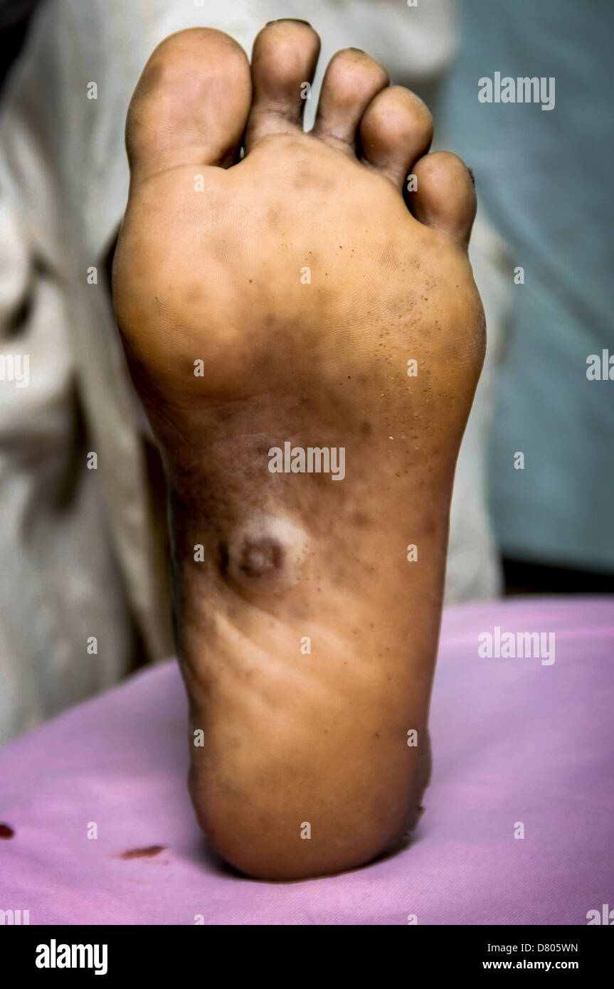 Myzetom auf dem alleinigen rechten Fuß eines Patienten. Stockfoto