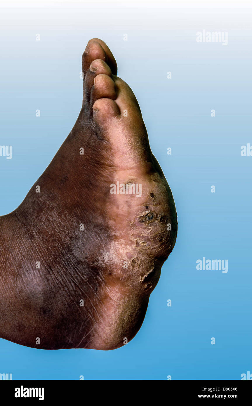 Myzetom auf dem linken Fuß eines jungen Mannes. Stockfoto