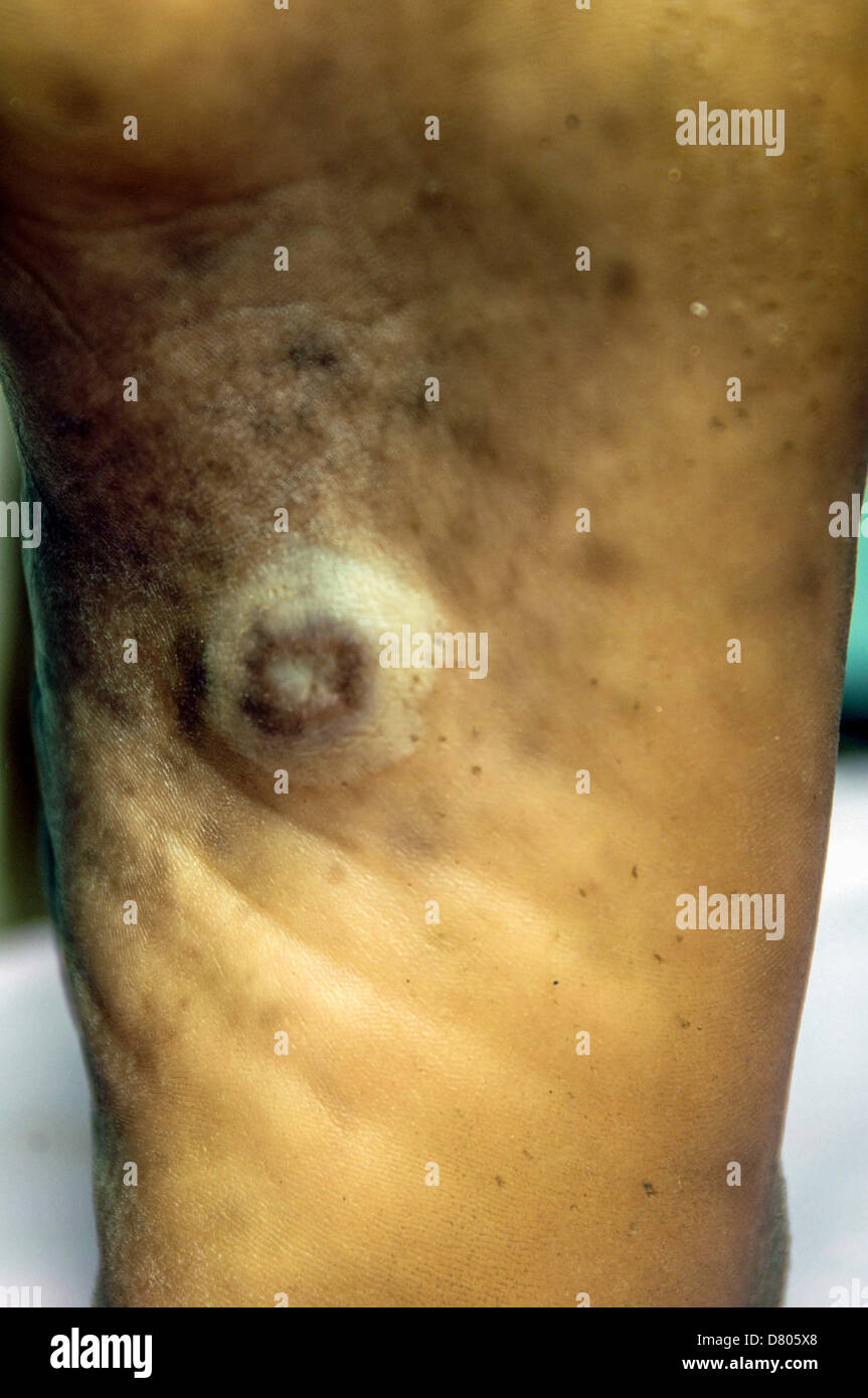 Myzetom auf dem alleinigen rechten Fuß eines Patienten. Stockfoto
