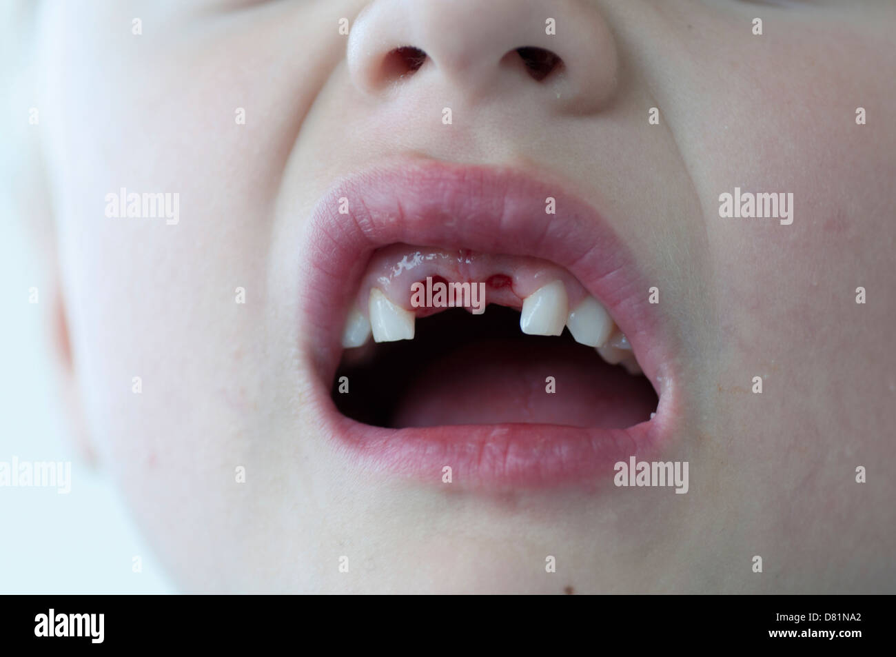 Sekunden nach dem Verlust der beiden oberen Milchzähne Stockfoto