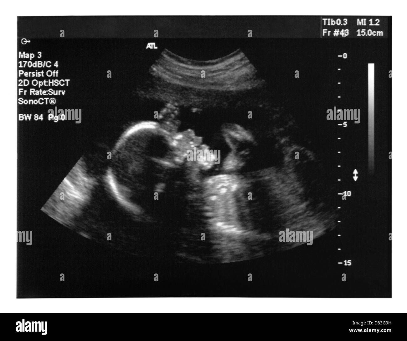 Lizenz verfügbar unter MaximImages.com - Ultraschall-Bildgebung eines Babys. Fünf Monate alter Fetus. Stockfoto