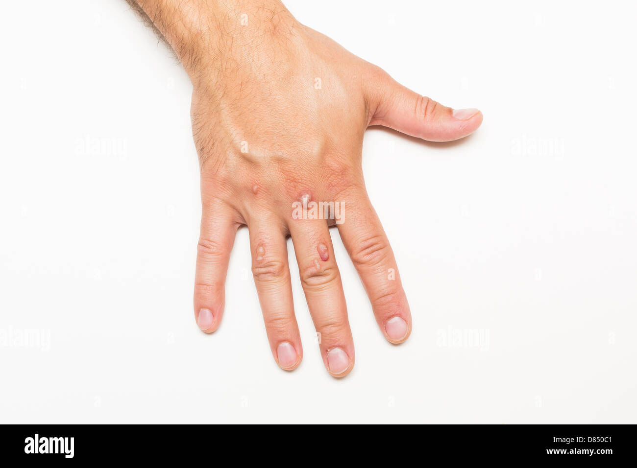 Hand des Mannes bedeckt mit Bläschen verursacht durch Kryochirurgie - Verfahren zum Entfernen Warze mit flüssigem Stickstoff Stockfoto