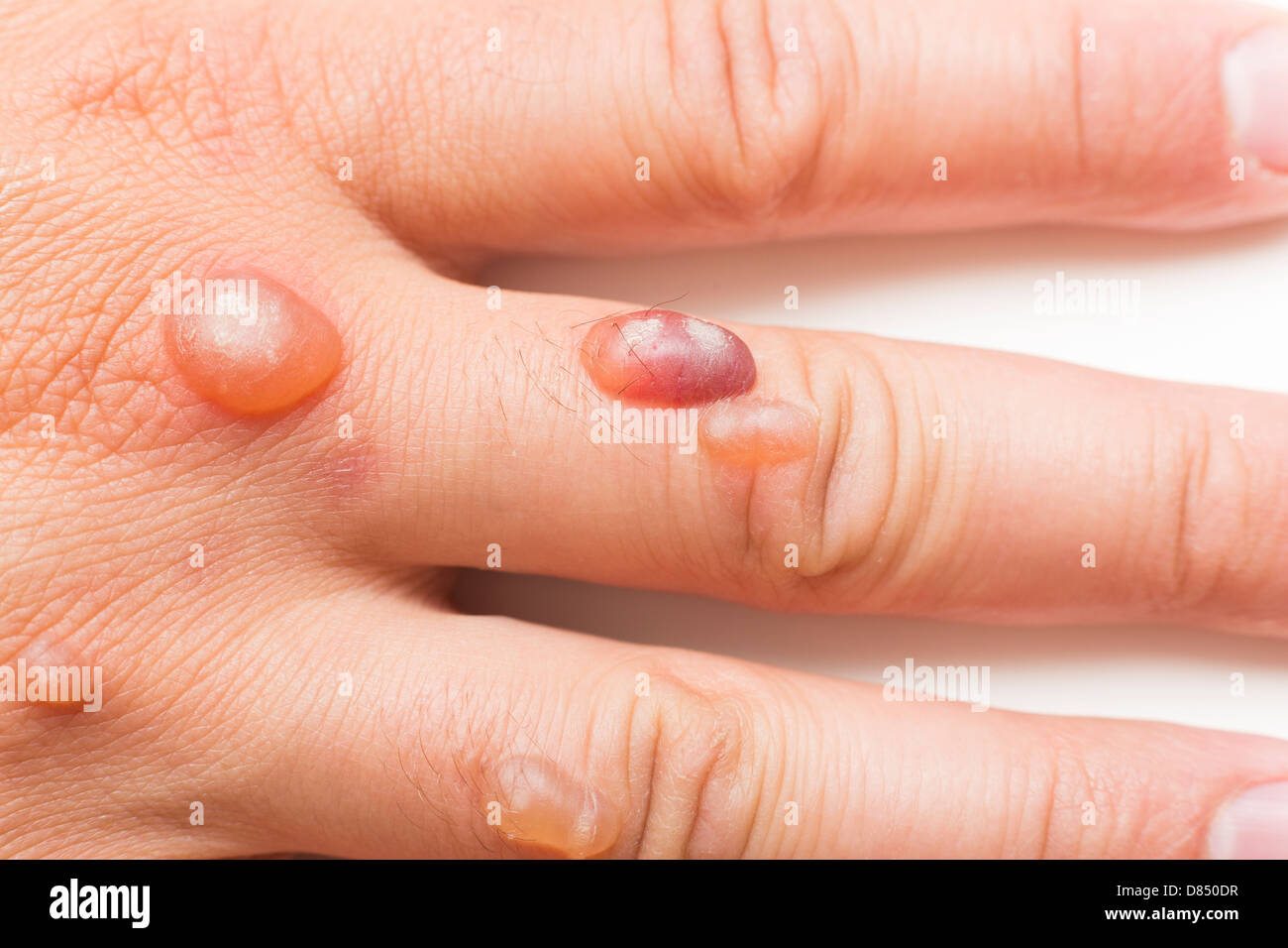 Hand Des Mannes Bedeckt Mit Blaschen Verursacht Durch Kryochirurgie Verfahren Zum Entfernen Warze Mit Flussigem Stickstoff Stockfotografie Alamy
