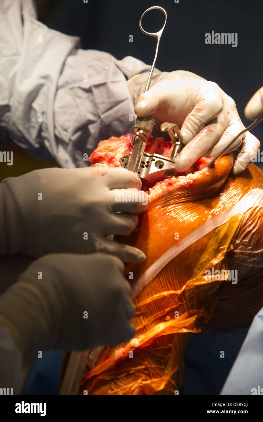 Knie-TEP Operation in einem Krankenhaus-Theater total Stockfoto