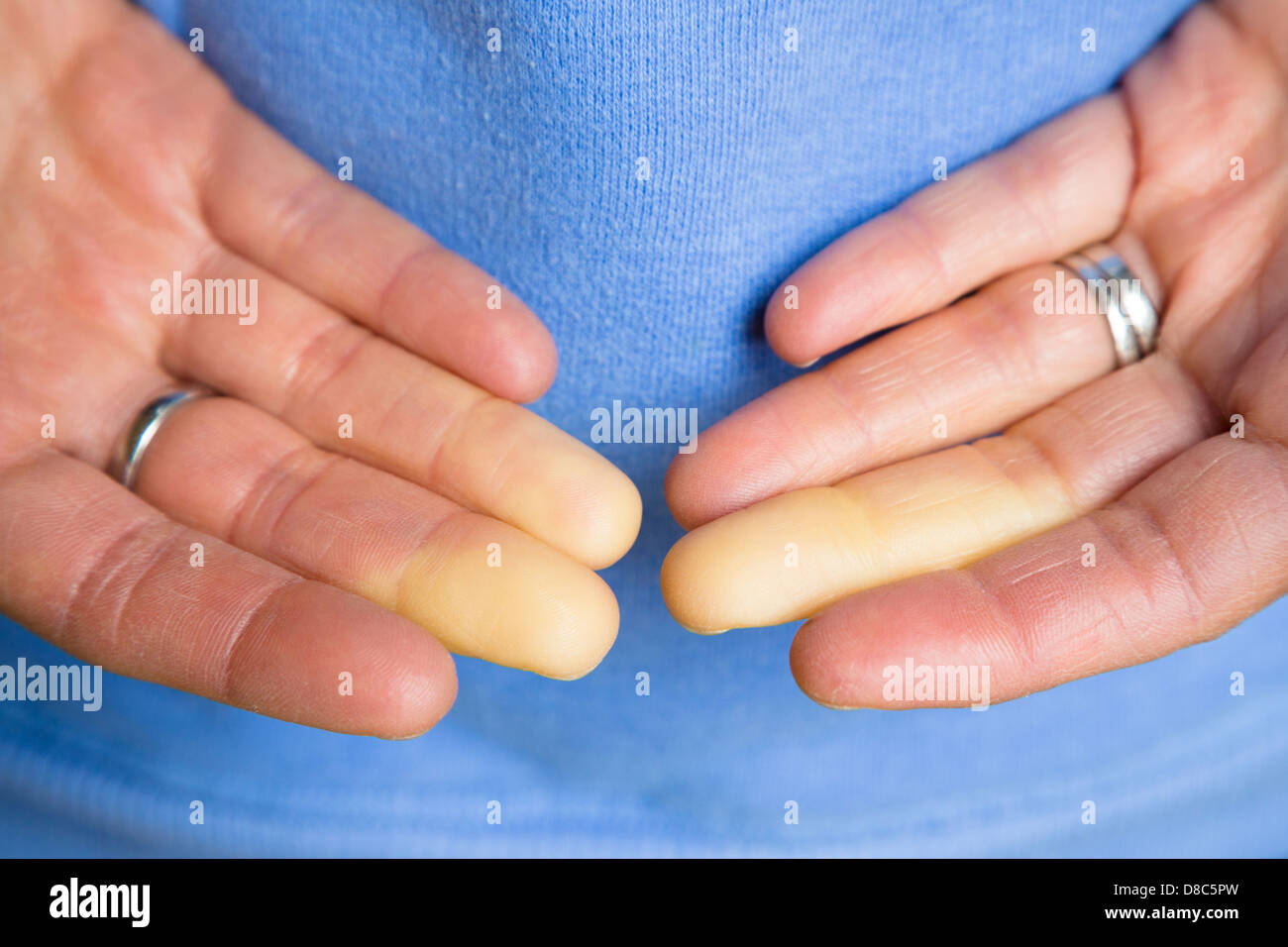 Detail der Frau Finger mit Raynaud-Phänomen hautnah. Vasospasmus schränkt die Durchblutung an den Fingern. Stockfoto