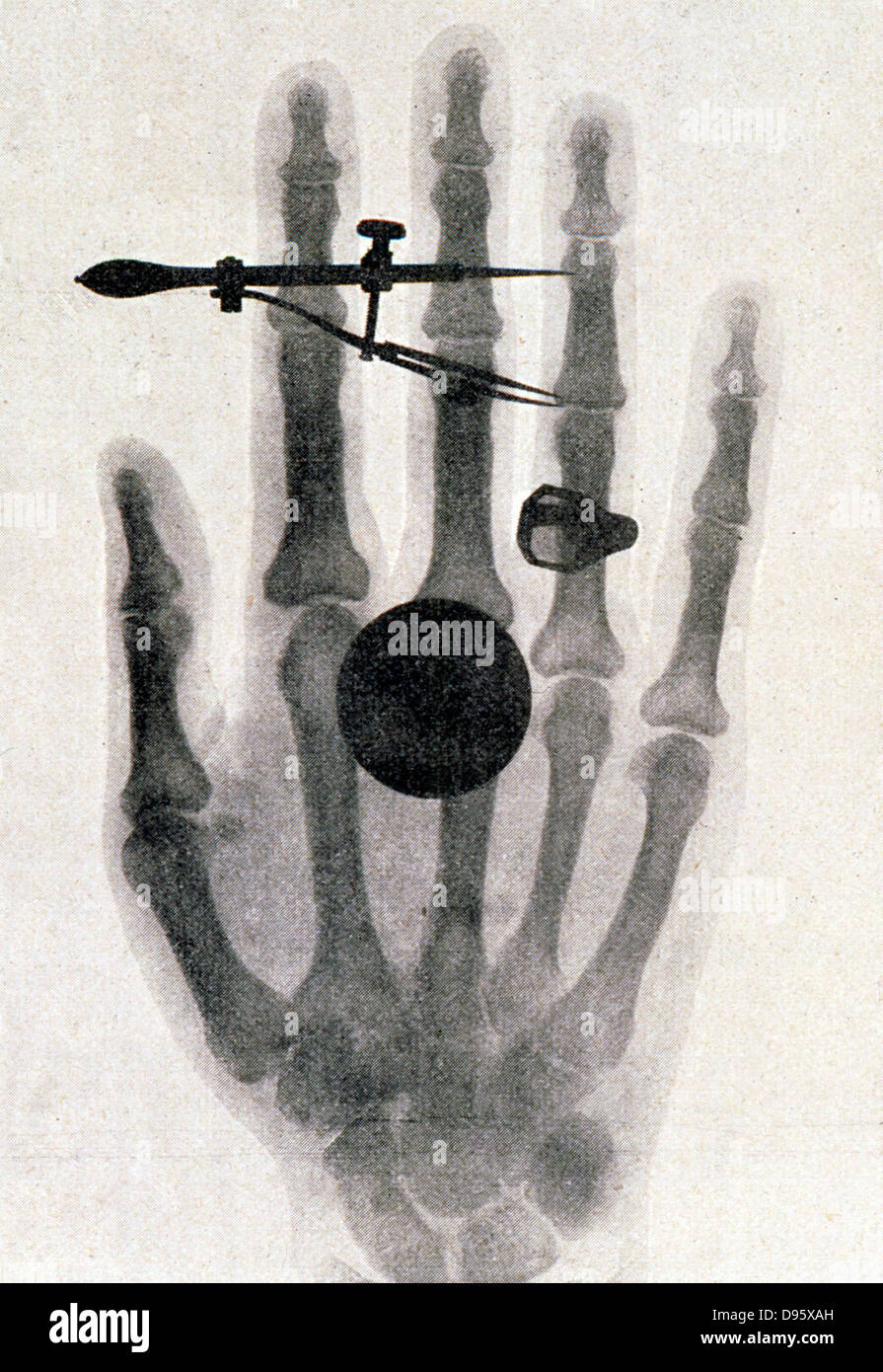 Wilhelm Röntgen (1845-1923) Röntgenaufnahme der Hand seiner Frau: 1896. Für seine Arbeit auf dem Gebiet der elektromagnetischen Strahlung und der Entdeckung der Röntgenstrahlen Röntgen verliehen 1901 Nobelpreis für Physik. Stockfoto