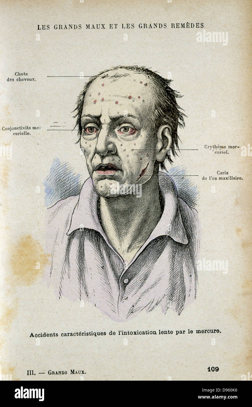 Symptome charakteristisch für langfristige Quecksilbervergiftung. Von Jules Rengade 'Les Grands Maux et les Grands Remedes", Paris, c 1890. Stockfoto