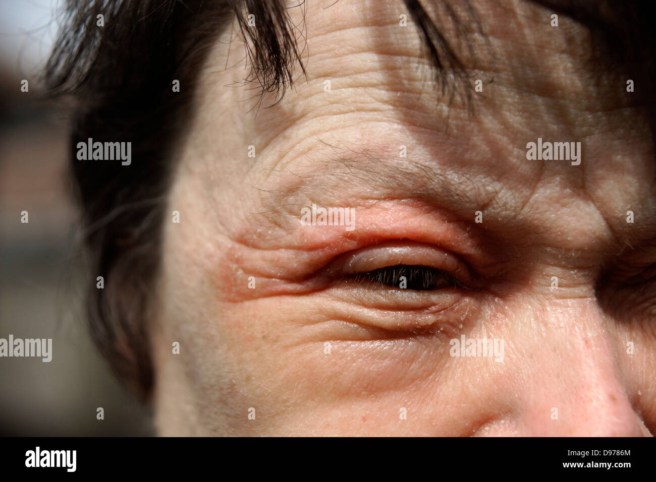 Frau leidet mit Ekzemen & einen Ausschlag für die meisten des Gesichtes mit dem Muskelkater umgebenden & Auswirkungen auf die Augen Stockfoto
