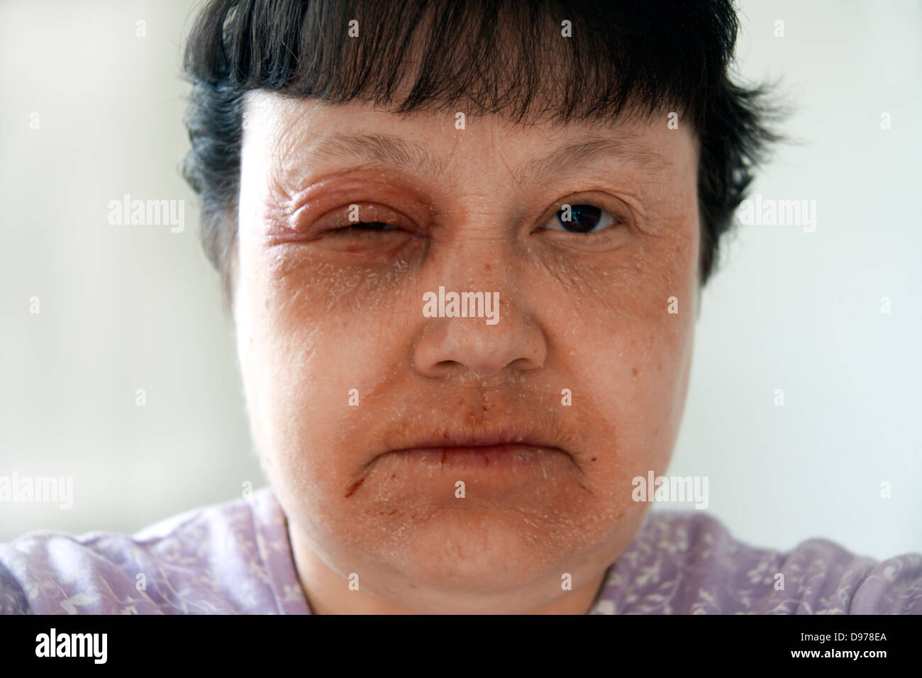 Frau mit Ekzemen & einen Ausschlag für die meisten des Gesichtes mit dem Muskelkater umgebenden & beeinflussen die Augen & Mundbereich leiden Stockfoto