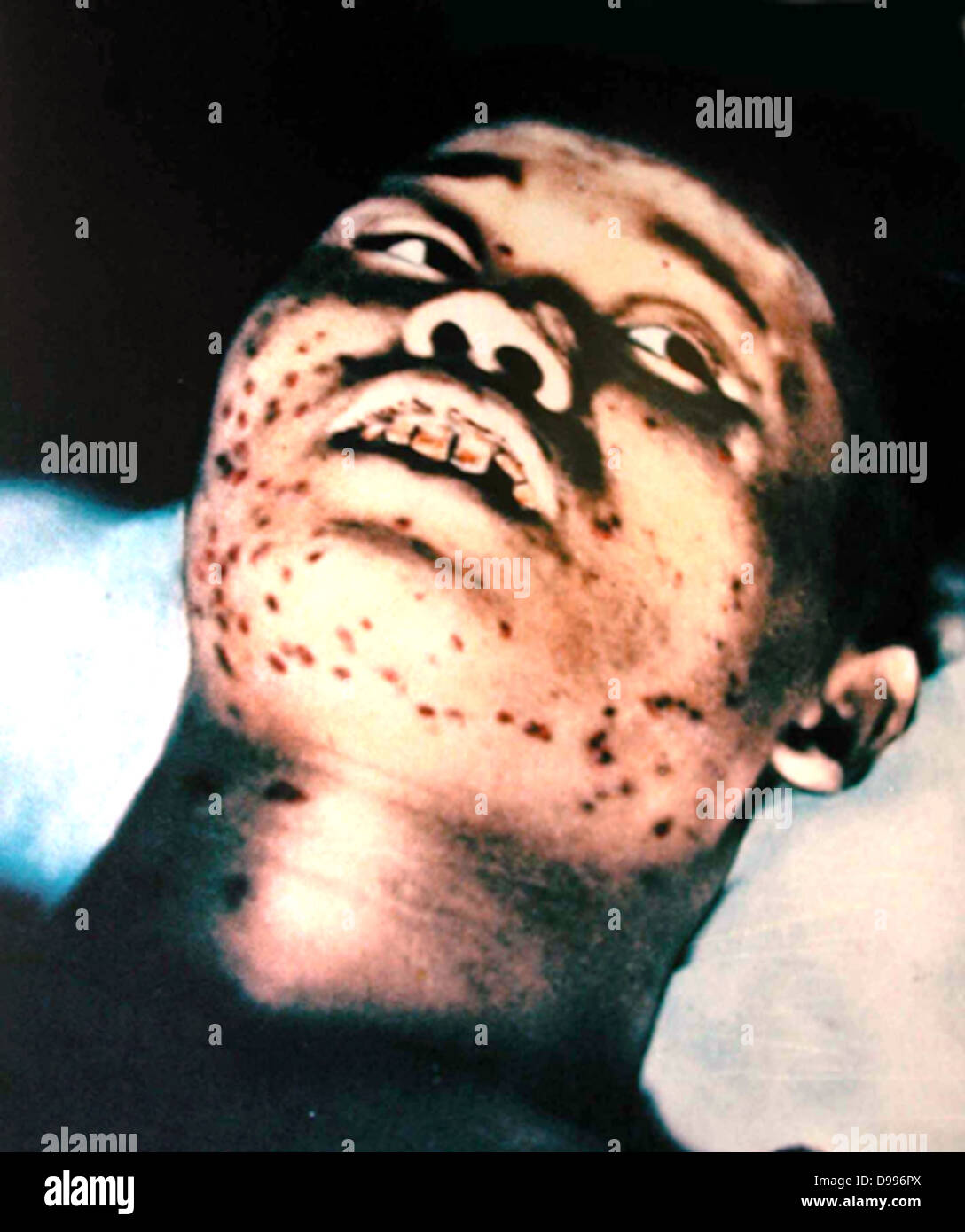 Opfer von Hiroshima Kernexplosion August 1945 Stockfoto