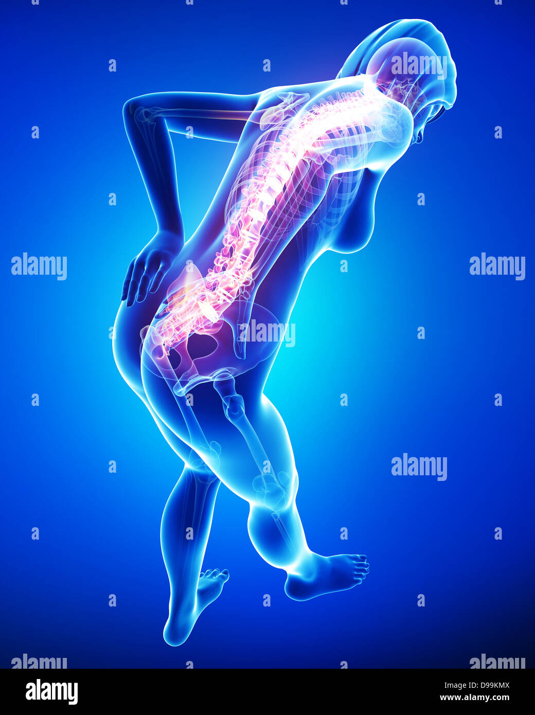 Rückenschmerzen bei weiblichen hervorgehoben Stockfoto