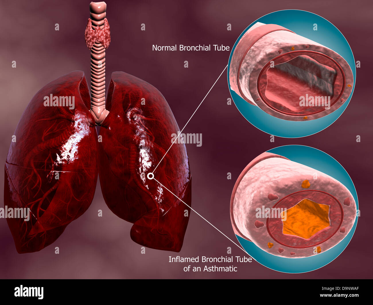 Luftröhre Querschnitt mit Lungen, zeigt der Vergleich der normalen und asthmatischen Bronchialsystem. Stockfoto