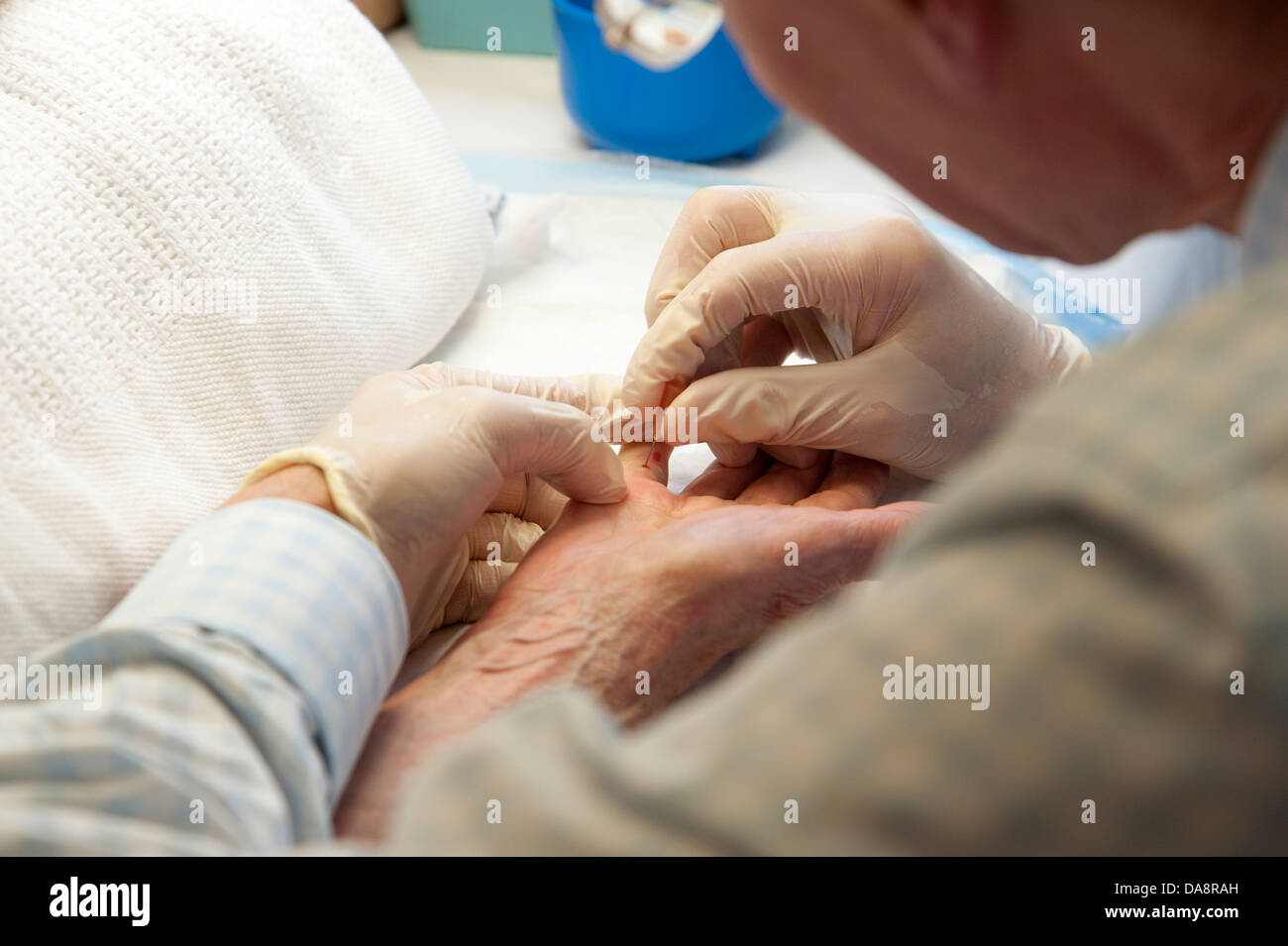 Der Dupuytren'schen Kontraktur Behandlung des kleinen Fingers auf eine Frau Hand Arzt mit Nadel, die Finger zu behandeln Stockfoto