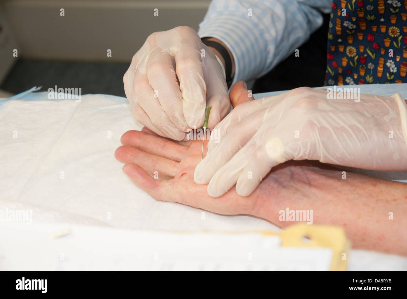 Der Dupuytren'schen Kontraktur Behandlung des kleinen Fingers auf eine Frau Hand Arzt mit Nadel, die Finger zu behandeln Stockfoto