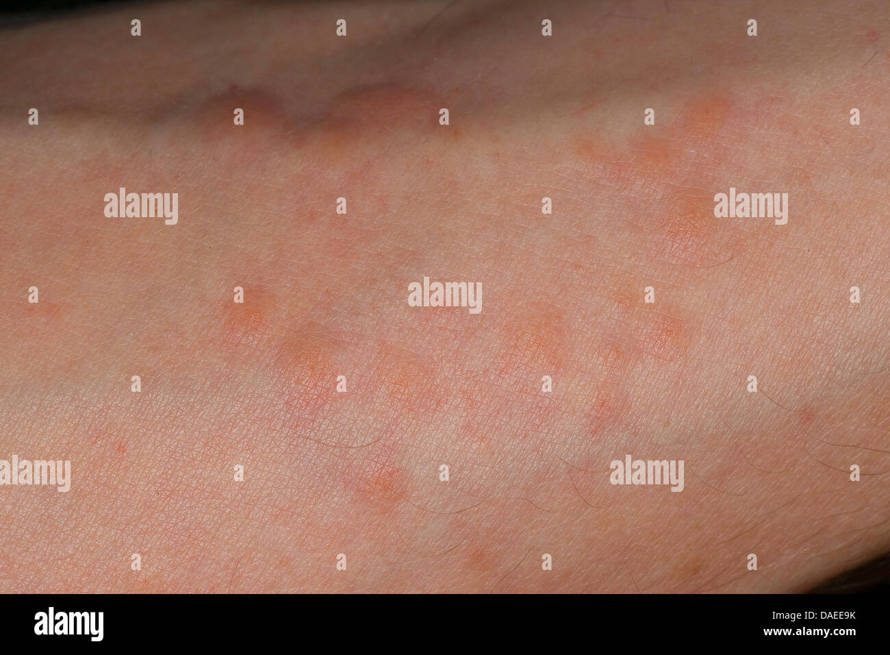 Brennnessel (Urtica Dioica), Reizung der Haut durch Brennessel, Deutschland Stockfoto
