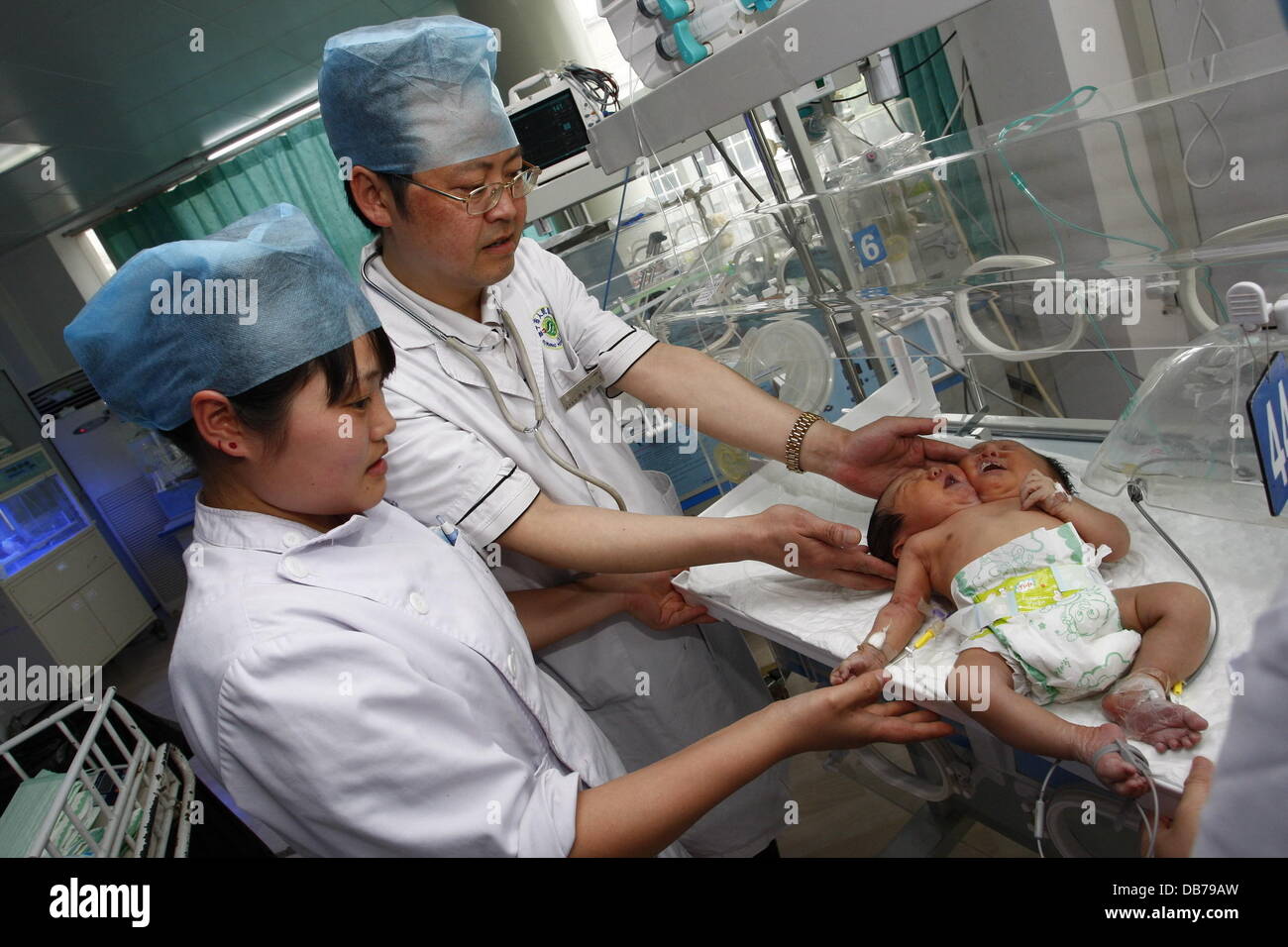 ZWEI Spitze BABY Conjoined weibliche Zwillinge waren am 5. Mai 2011 in Suining Stadt geboren. Beiden vorangegangenen Ultraschall scannt im September und Februar beide Revealled nur einen einzigen Embryo, aber eine endgültige-zwei Tage vor der Geburt Revealled Scan, die Tochter der Mutter Stockfoto