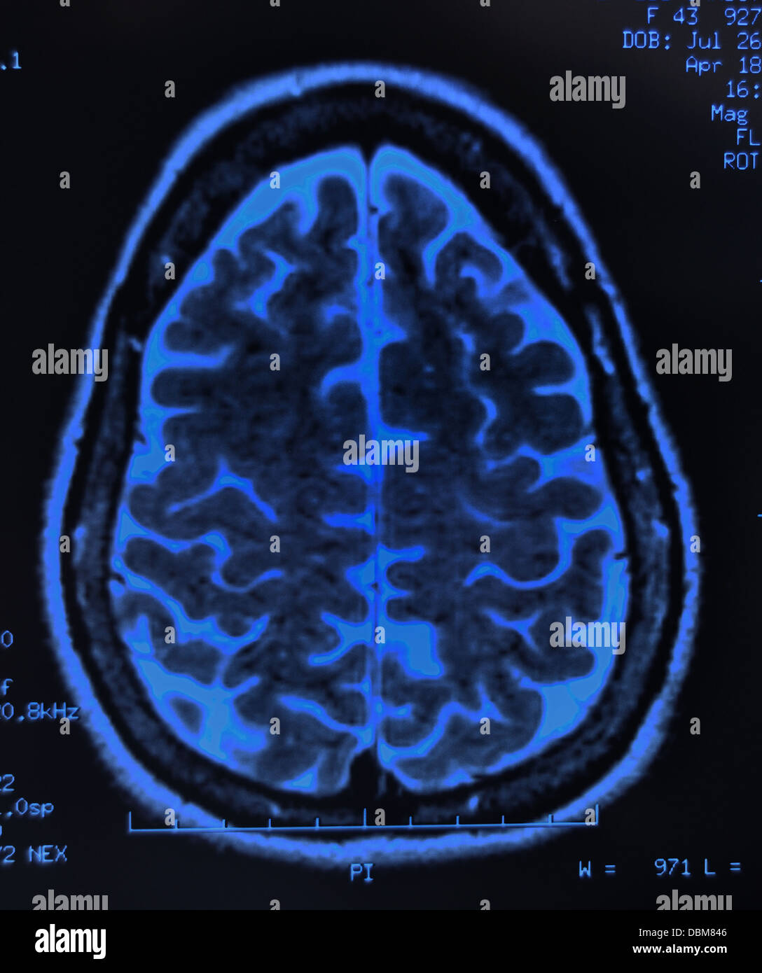 Human Brain Scan/MRT, X-ray Stockfoto