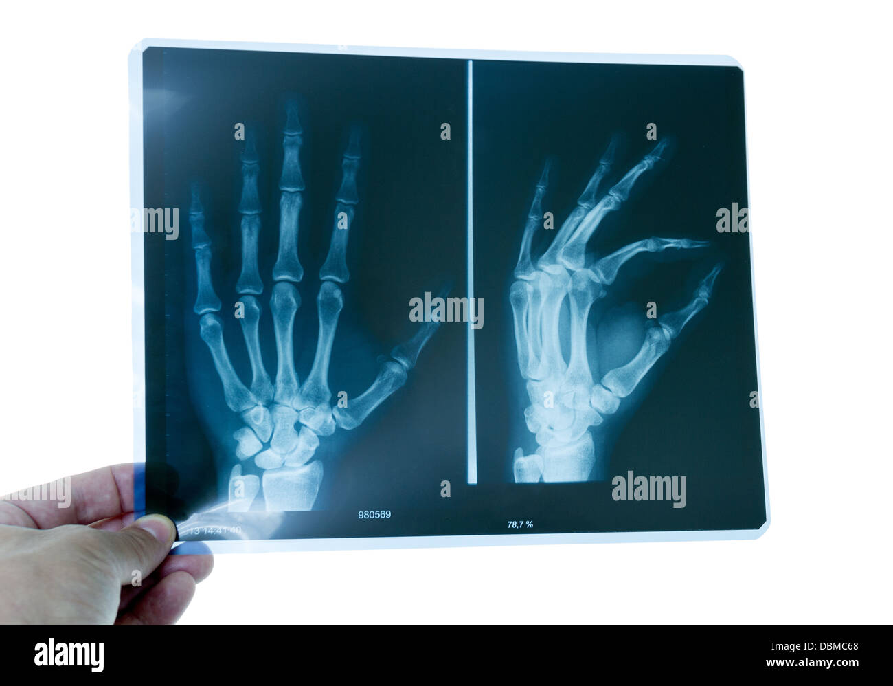 Arzt untersucht eine Hand-Radiographie Stockfoto