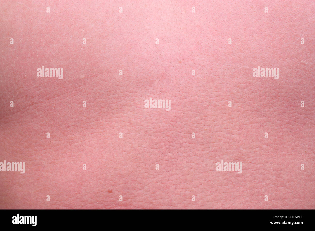 Beispiel-Sonnenbrand-Wärme Hautausschlag Haut brennen Stockfotografie