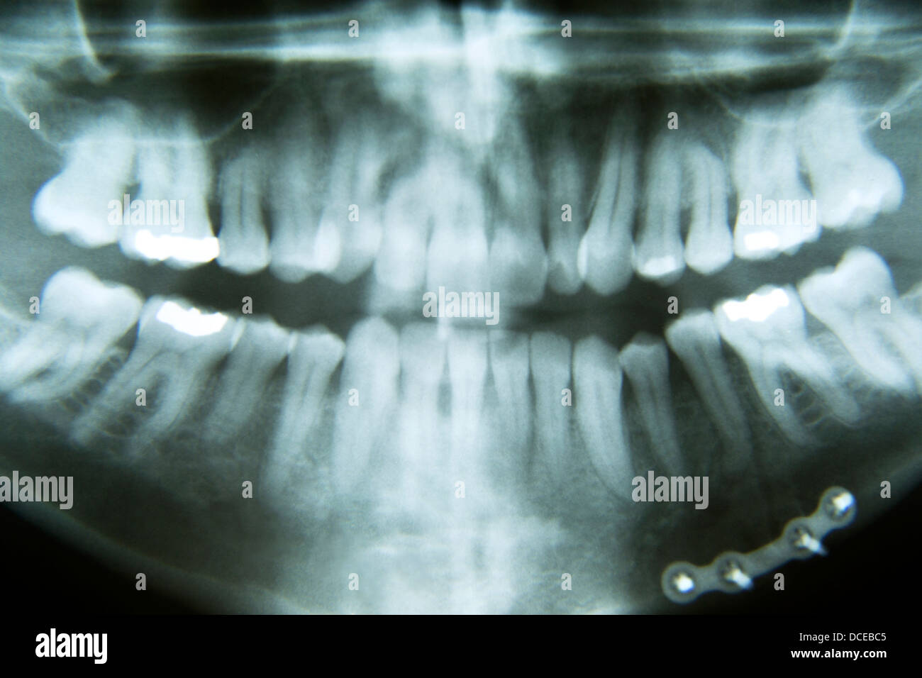 Panorama-Röntgenaufnahme des Kiefers Fraktur Reparatur Stockfoto