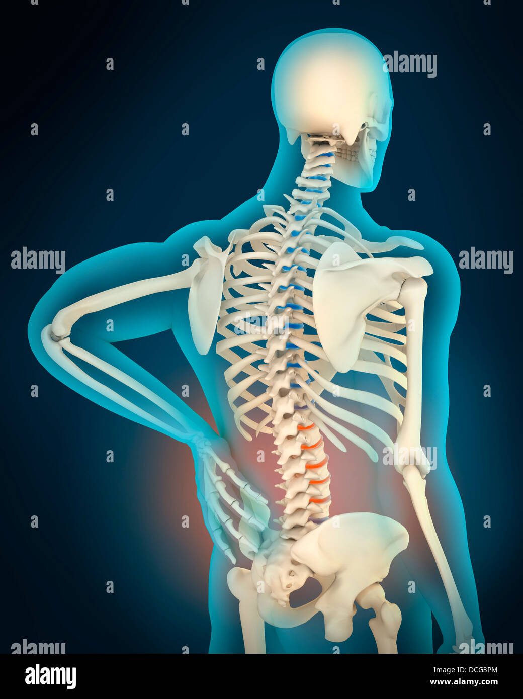 Medizinische Illustration zeigt Entzündungen und Schmerzen im menschlichen Rückenbereich, perspektivische Ansicht. Stockfoto