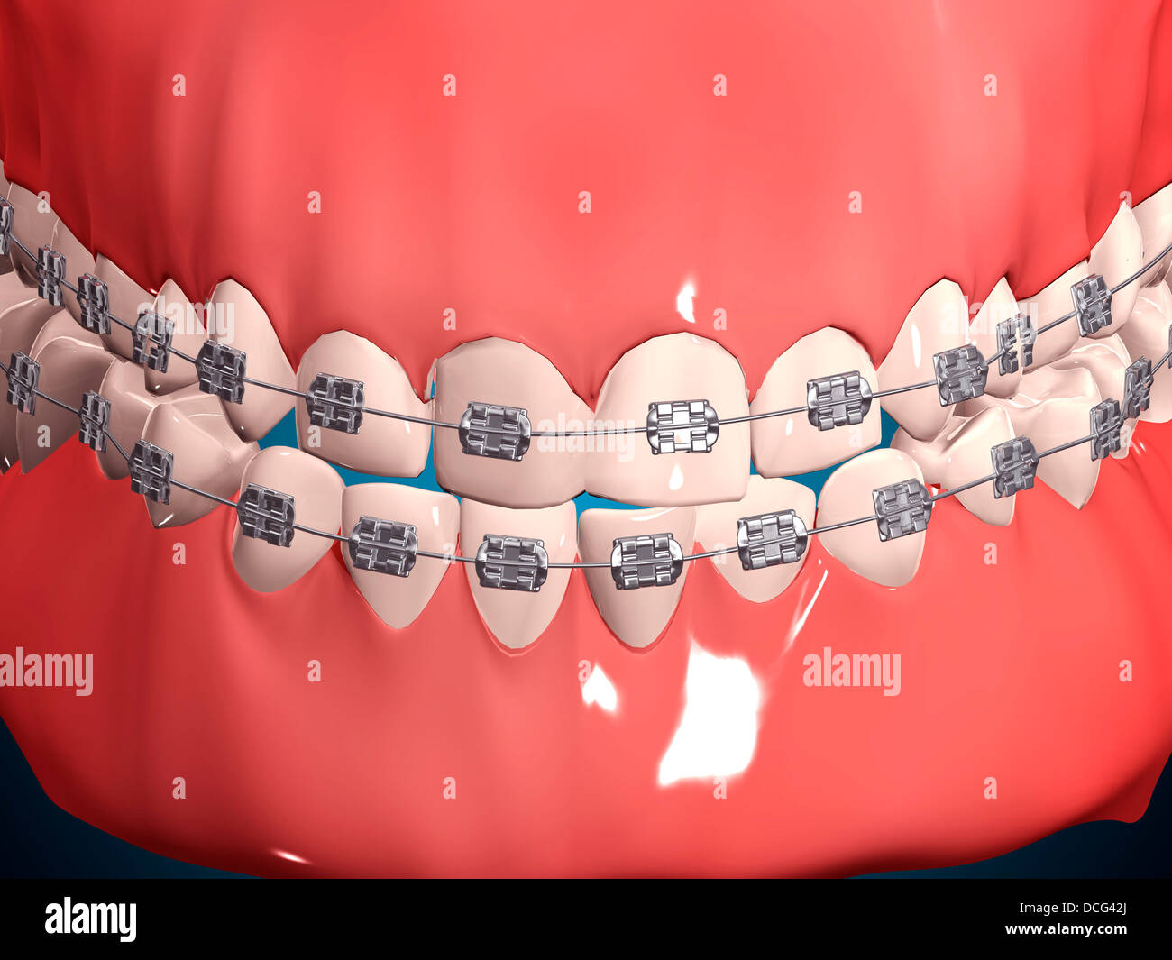 Medizinische Illustration der menschliche Mund zeigt Zähne, Zahnfleisch und Metall-Klammern. Stockfoto