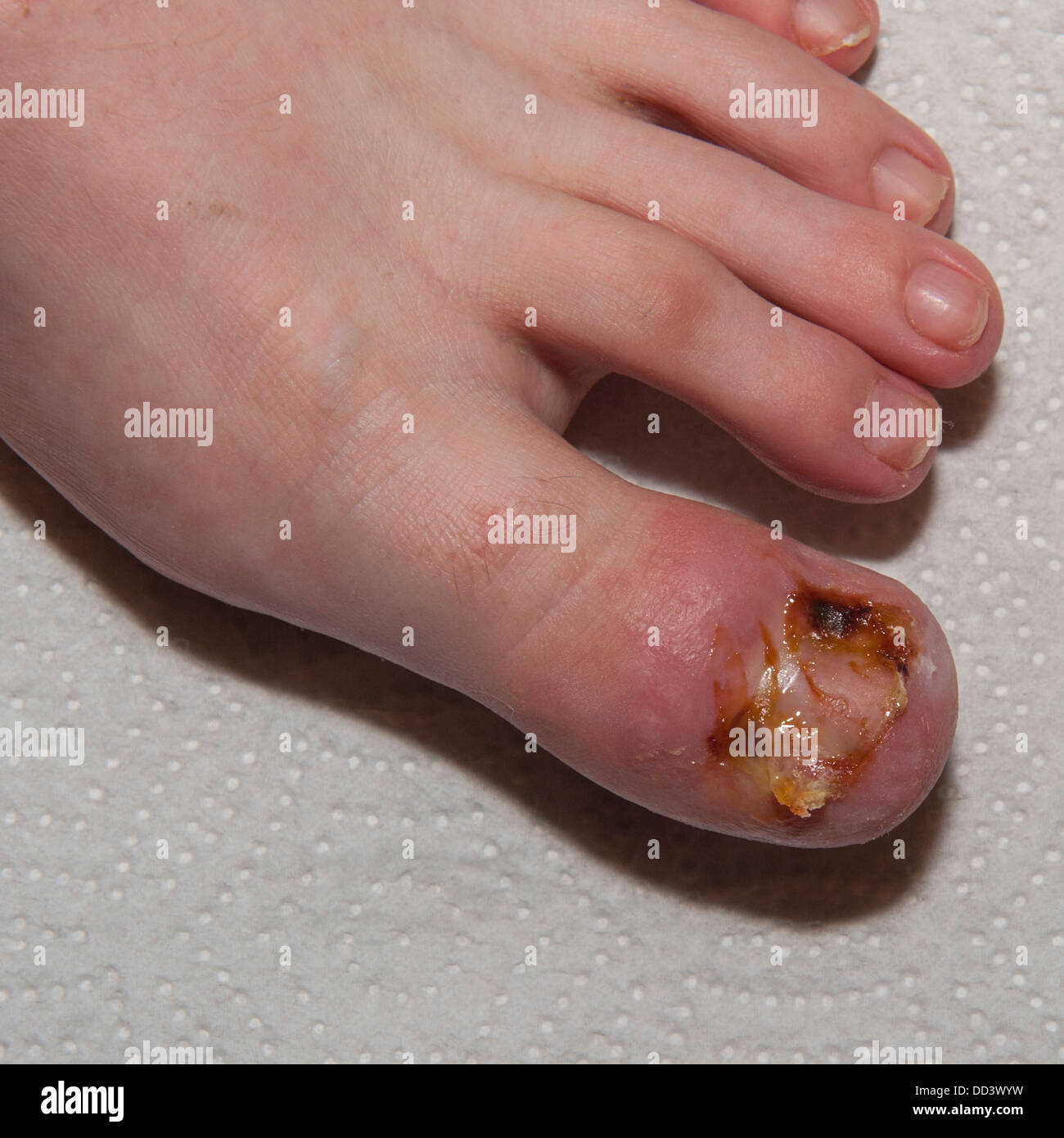 Eine 13 jhrige Jungen Toe nachdem er die Seiten des Nagels entfernt, da  sie eingewachsene Stockfotografie - Alamy
