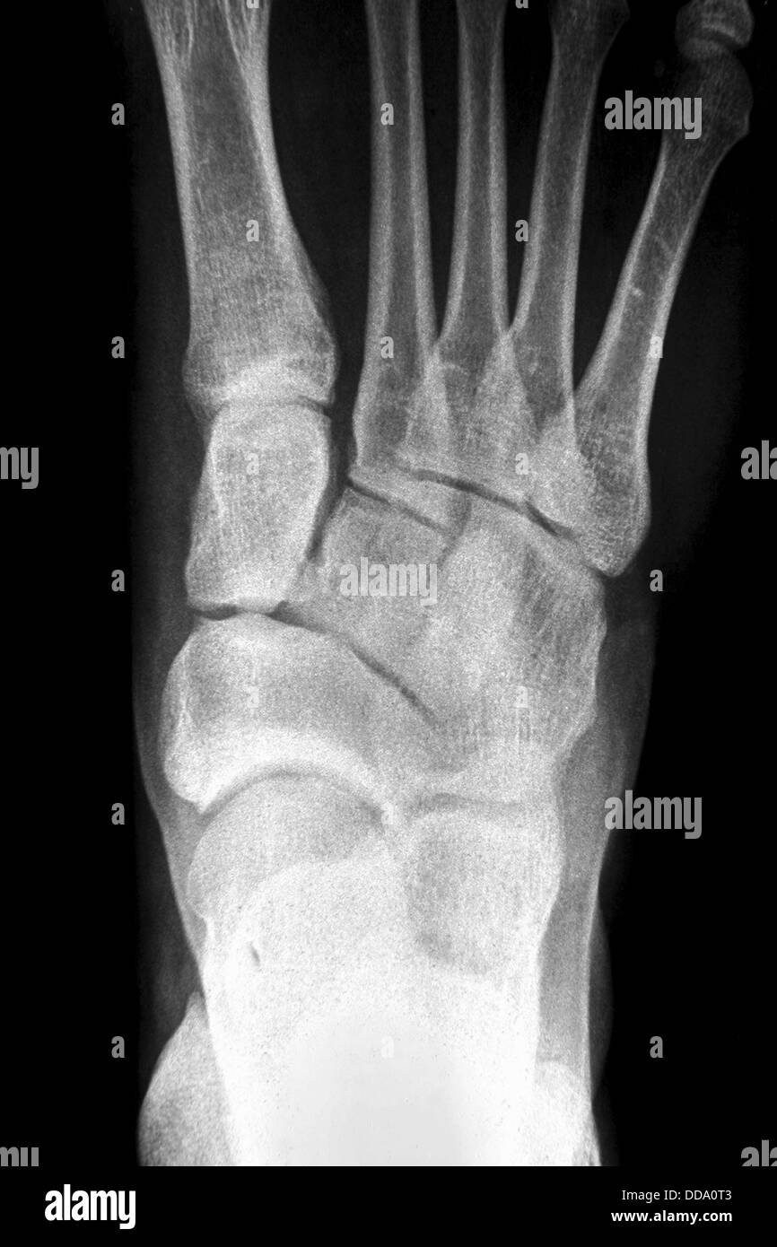 Röntgen fuß Schwarzweiß-Stockfotos und -bilder - Alamy