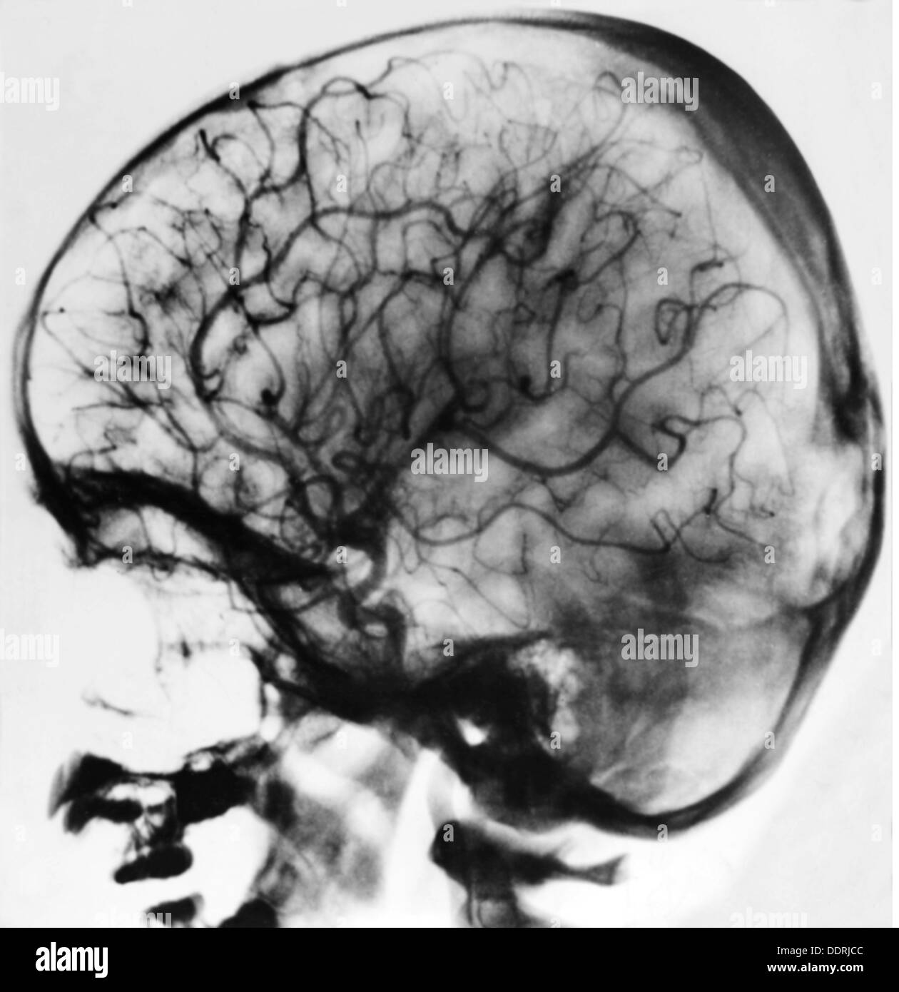 Medizin, Anatomie, Großhirn / Schädel, Angiographie eines menschlichen Kopfes, Foto der neurochirurgischen Klinik des Hufeland-Krankenhauses, Berlin, 20. Jahrhundert, Angiographie, röntgenblickendes Material, Gehirn, Gehirn, Blutgefäße, Blutfluss, Durchblutung, Durchblutung, Durchblutung, Röntgenbild, Röntgenbild, Röntgenbild, Röntgenbilder, Röntgenbilder, Röntgenbilder, Röntgenbilder, Röntgenbilder, Medizin, Medizin, Klinik, Kliniken, historisch, historisch, zusätzliche-Rechte-Clearences-nicht verfügbar Stockfoto